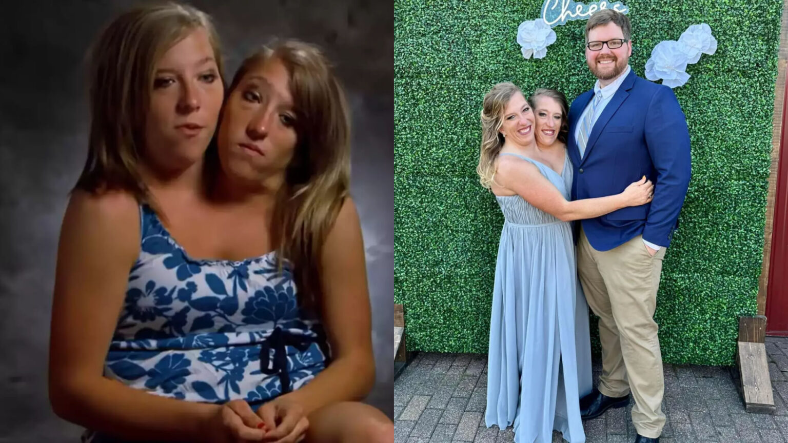 Siamesische Zwillinge Abby und Brittany